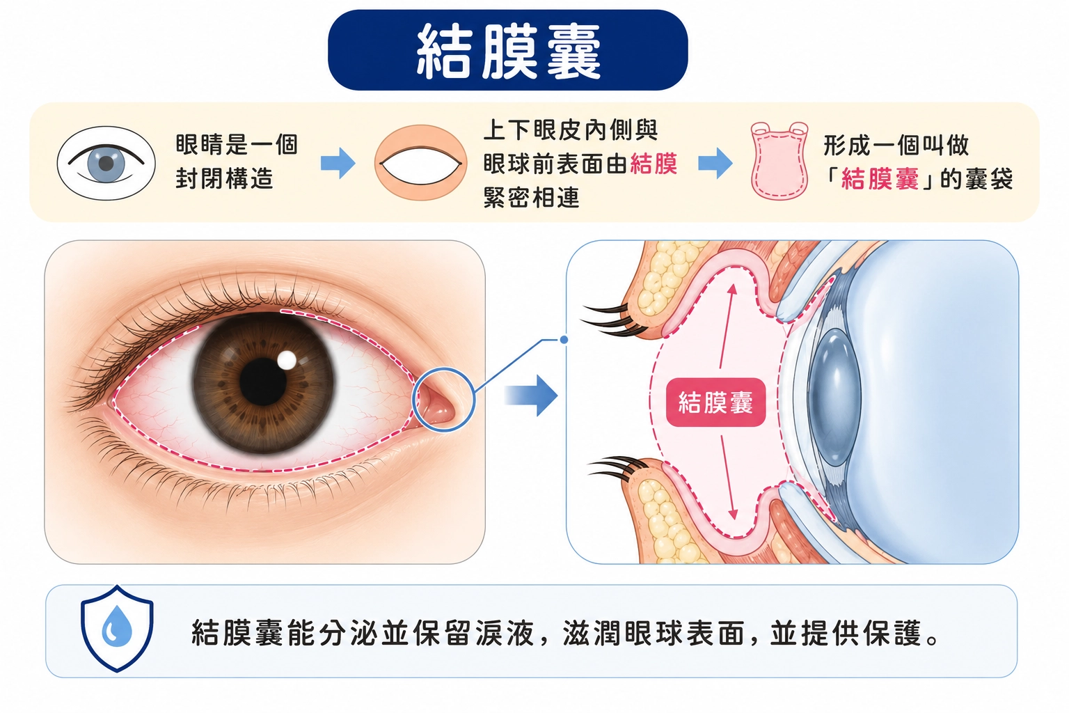 我們的眼睛是一個封閉構造，上下眼皮內側與眼球前表面由結膜緊密相連，形成一個叫做「 結膜囊 」的囊袋。